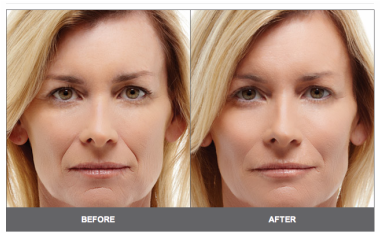before and after results from anti aging face lift kelowna