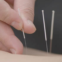 An closeup of an acupuncture treatment.
